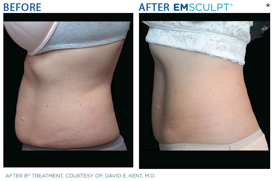 Emsculpt® San Francisco