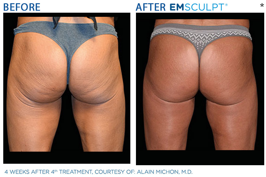 Emsculpt® San Francisco